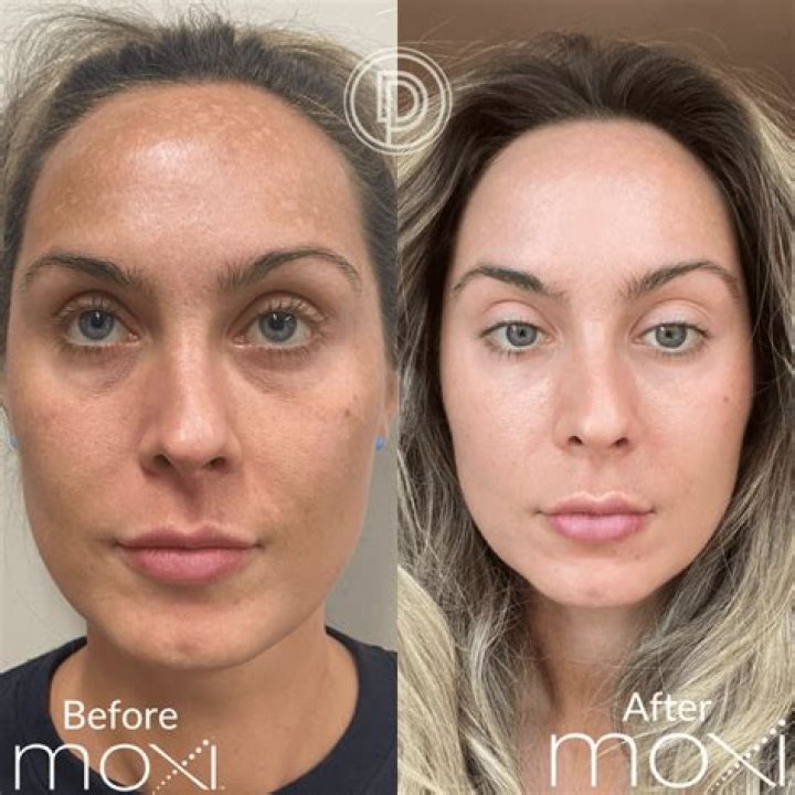 Before and after
