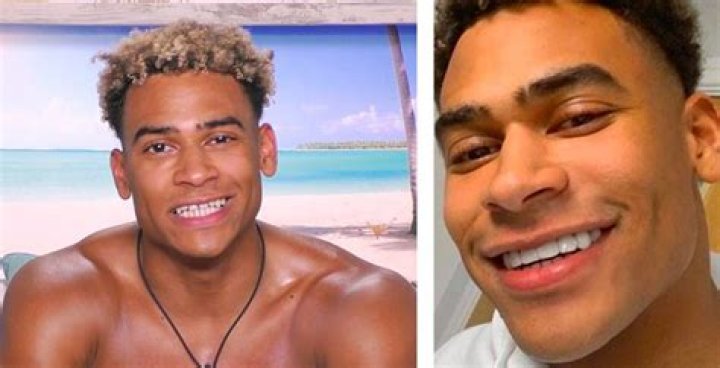 Marco Love Island Teeth