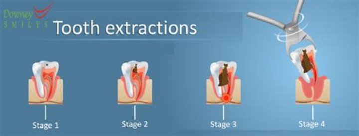 paying for tooth extraction without insurance